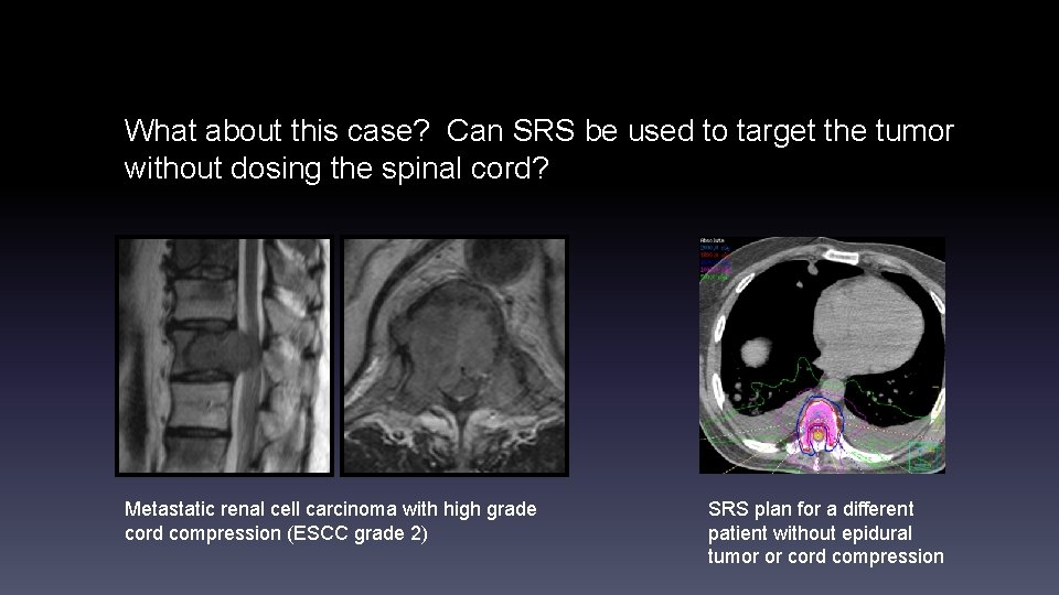 What about this case? Can SRS be used to target the tumor without dosing