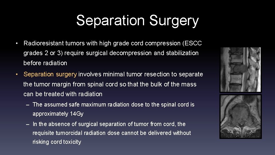 Separation Surgery • Radioresistant tumors with high grade cord compression (ESCC grades 2 or