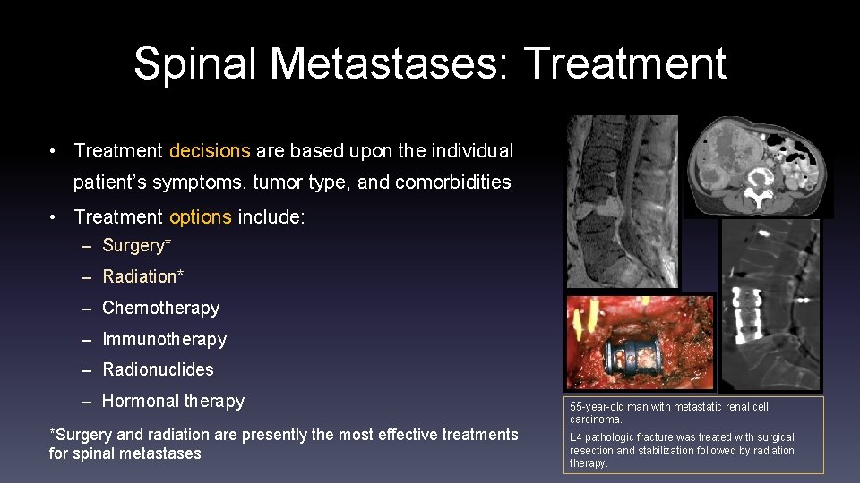 Spinal Metastases: Treatment • Treatment decisions are based upon the individual patient’s symptoms, tumor