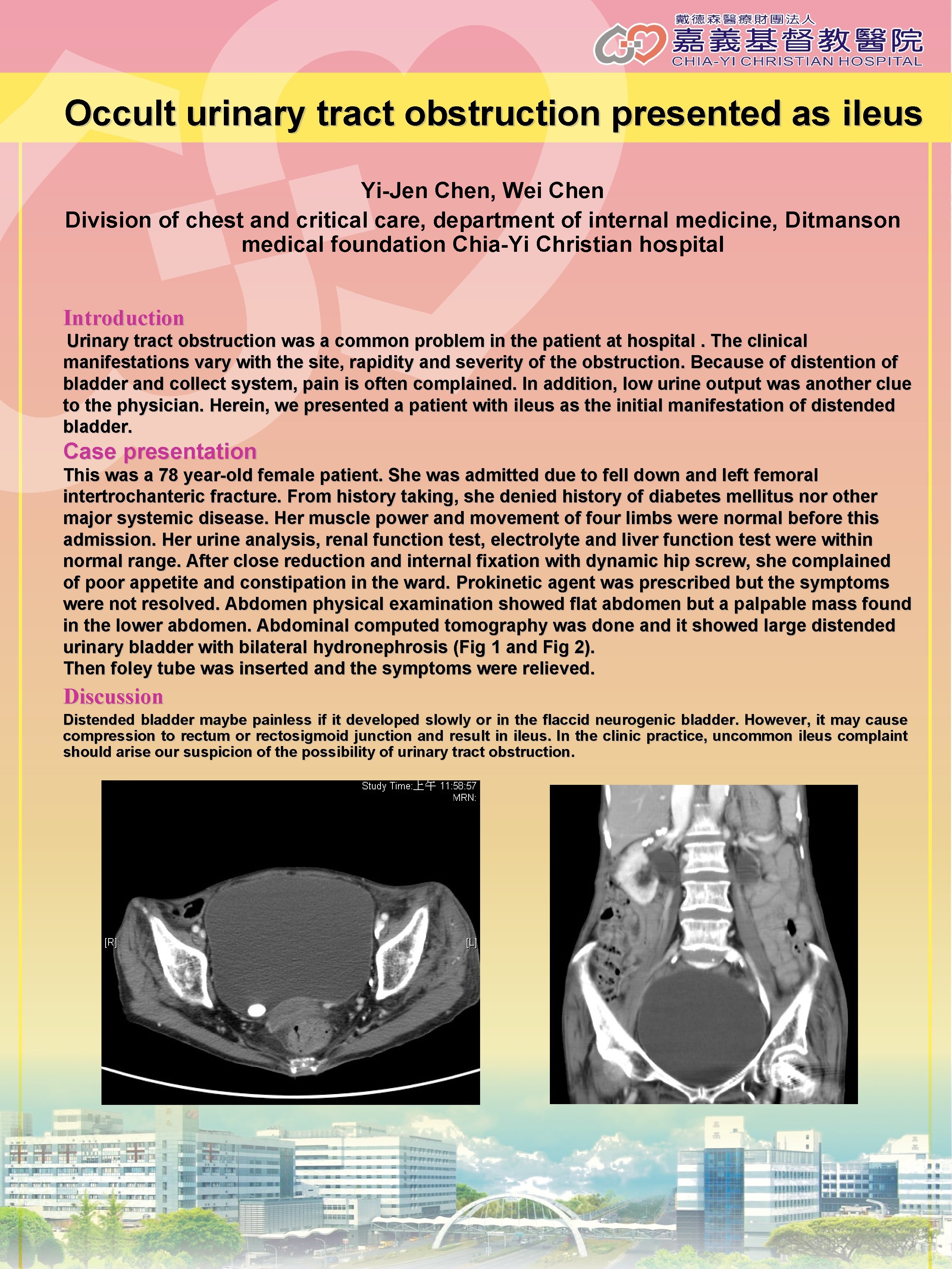 Occult urinary tract obstruction presented as ileus Yi-Jen Chen, Wei Chen Division of chest