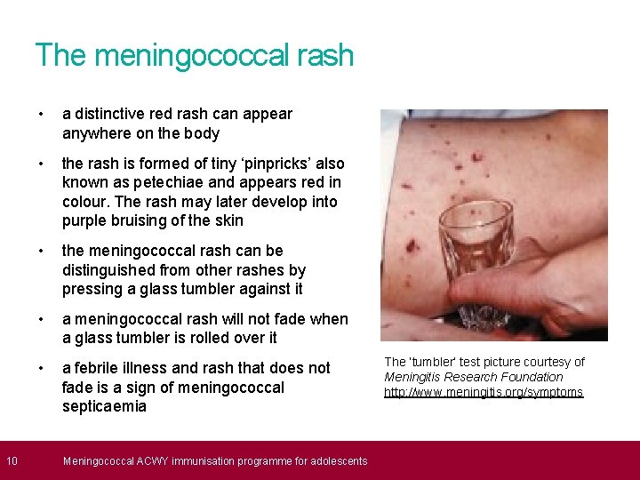  10 The meningococcal rash • a distinctive red rash can appear anywhere on