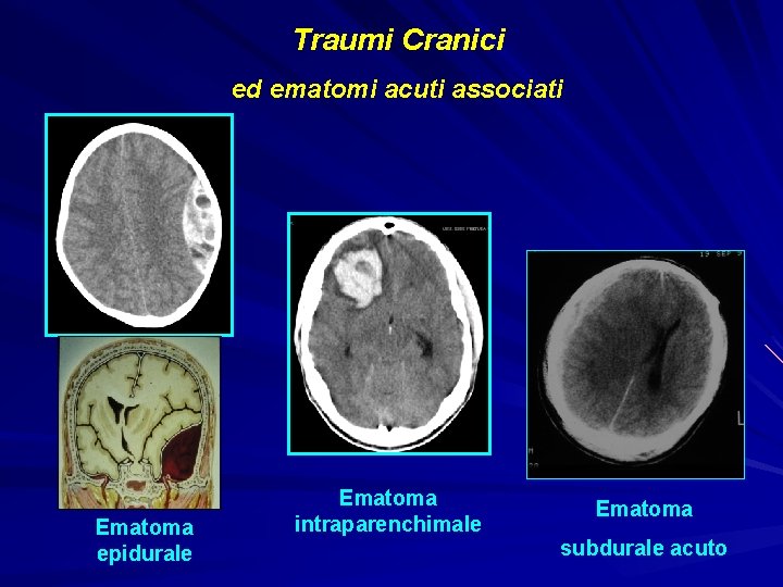 Traumi Cranici ed ematomi acuti associati Ematoma epidurale Ematoma intraparenchimale Ematoma subdurale acuto 