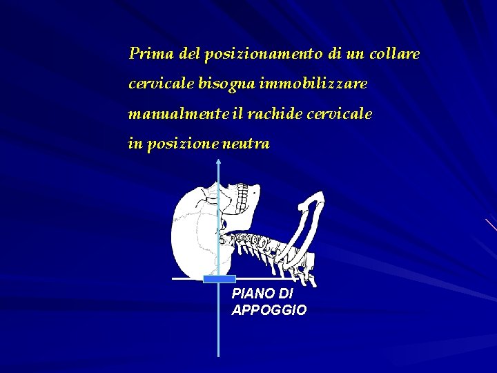 Prima del posizionamento di un collare cervicale bisogna immobilizzare manualmente il rachide cervicale in