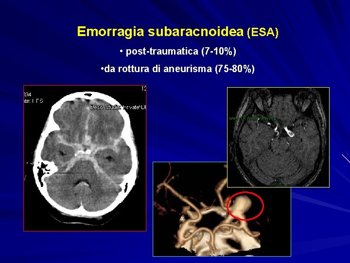 Emorragia subaracnoidea (ESA) • post-traumatica (7 -10%) • da rottura di aneurisma (75 -80%)