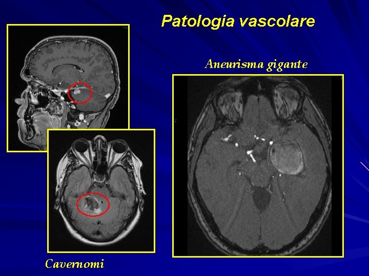 Patologia vascolare Aneurisma gigante Cavernomi 