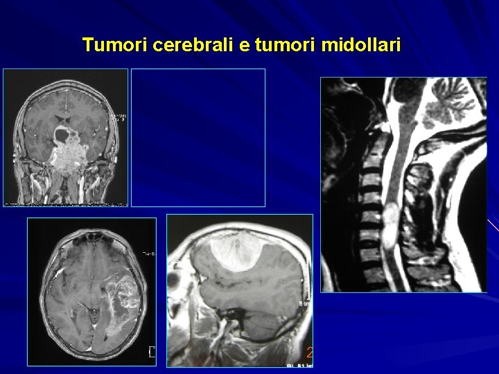 Tumori cerebrali e tumori midollari 