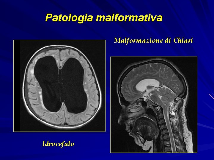 Patologia malformativa Malformazione di Chiari Idrocefalo 