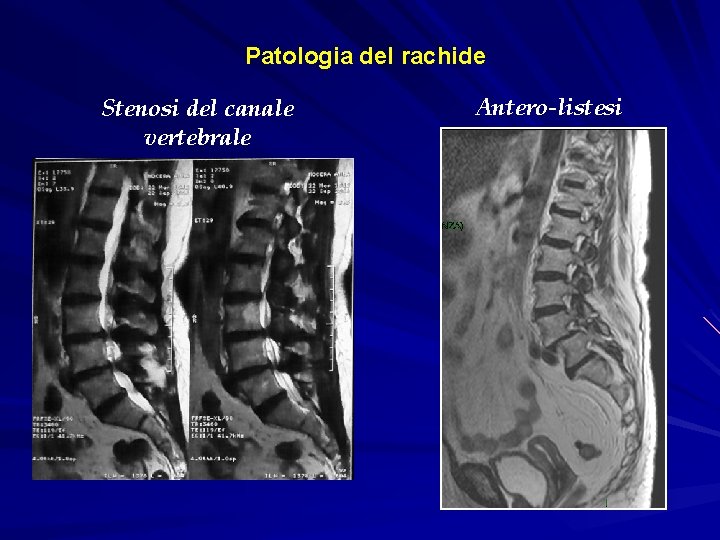 Patologia del rachide Stenosi del canale vertebrale Antero-listesi 