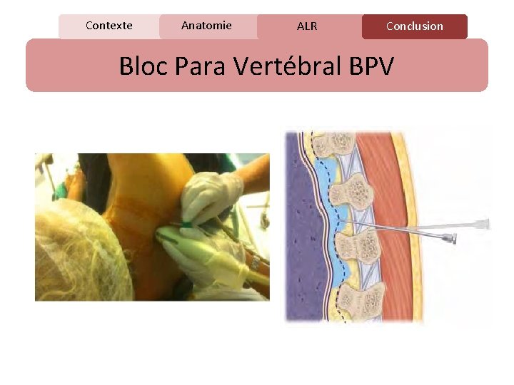 Contexte Anatomie C ALR Conclusion Bloc Para Vertébral BPV 