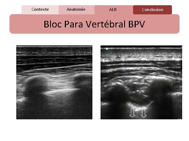 Contexte Anatomie C ALR Conclusion Bloc Para Vertébral BPV 