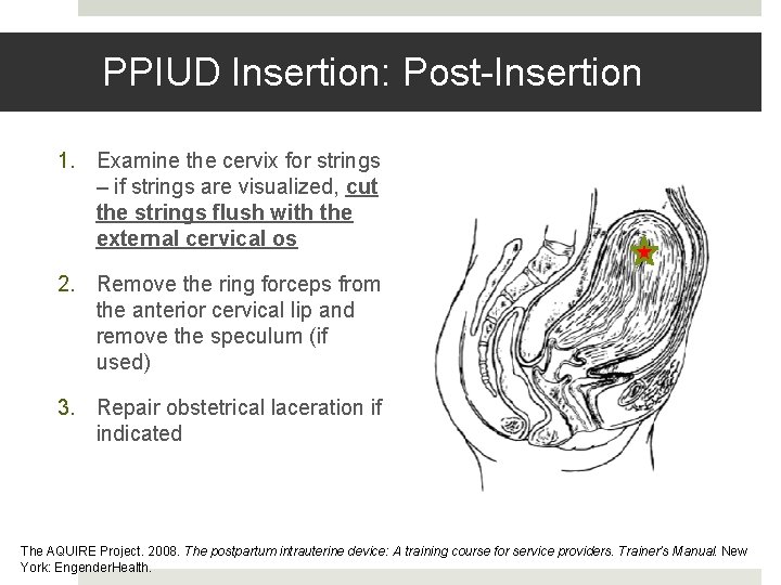 PPIUD Insertion: Post-Insertion 1. Examine the cervix for strings – if strings are visualized, PPIUD Insertion: Post-Insertion 1. Examine the cervix for strings – if strings are visualized,