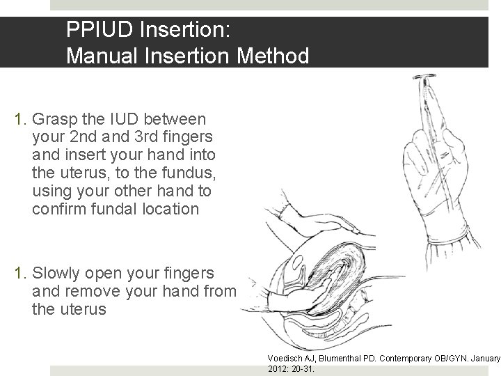 PPIUD Insertion: Manual Insertion Method 1. Grasp the IUD between your 2 nd and PPIUD Insertion: Manual Insertion Method 1. Grasp the IUD between your 2 nd and
