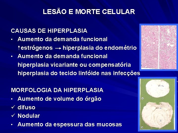 LESÃO E MORTE CELULAR CAUSAS DE HIPERPLASIA • Aumento da demanda funcional estrógenos hiperplasia