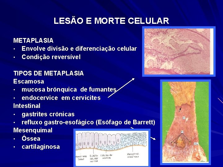 LESÃO E MORTE CELULAR METAPLASIA • Envolve divisão e diferenciação celular • Condição reversível