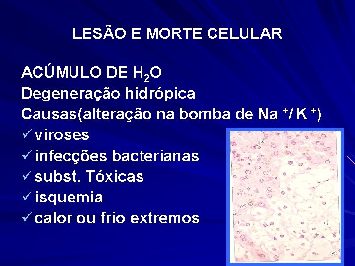 LESÃO E MORTE CELULAR ACÚMULO DE H 2 O Degeneração hidrópica Causas(alteração na bomba