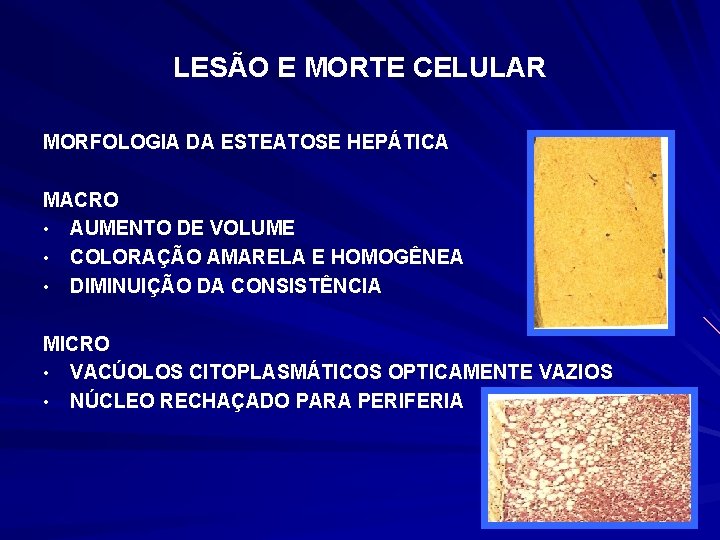 LESÃO E MORTE CELULAR MORFOLOGIA DA ESTEATOSE HEPÁTICA MACRO • AUMENTO DE VOLUME •