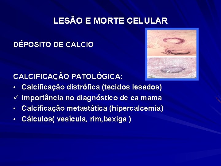 LESÃO E MORTE CELULAR DÉPOSITO DE CALCIO CALCIFICAÇÃO PATOLÓGICA: • Calcificação distrófica (tecidos lesados)