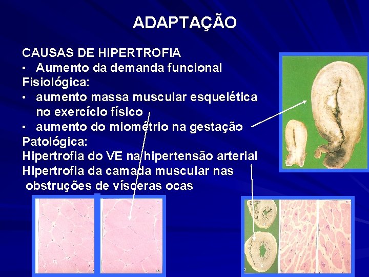 ADAPTAÇÃO CAUSAS DE HIPERTROFIA • Aumento da demanda funcional Fisiológica: • aumento massa muscular