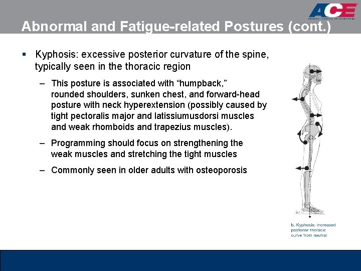 Abnormal and Fatigue-related Postures (cont. ) § Kyphosis: excessive posterior curvature of the spine, Abnormal and Fatigue-related Postures (cont. ) § Kyphosis: excessive posterior curvature of the spine,