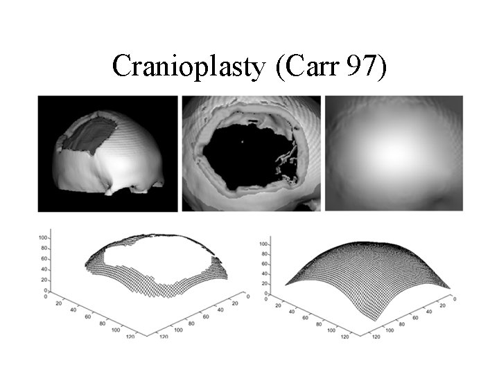 Cranioplasty (Carr 97) 