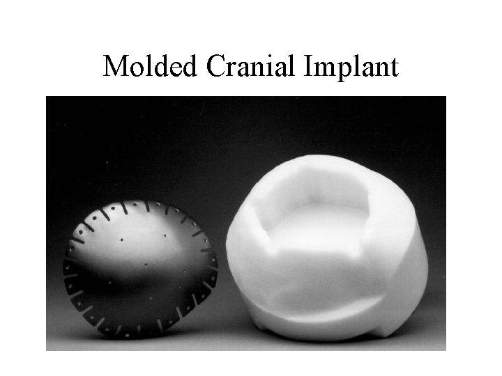 Molded Cranial Implant 