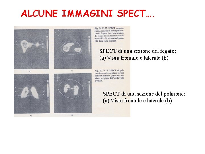 ALCUNE IMMAGINI SPECT…. SPECT di una sezione del fegato: (a) Vista frontale e laterale