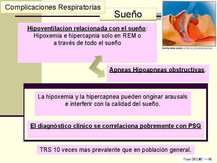 Complicaciones Respiratorias Sueño Hipoventilacion relacionada con el sueño: Hipoxemia e hipercapnia solo en REM