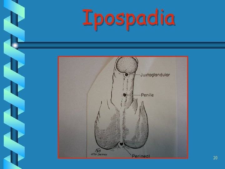 Ipospadia 20 