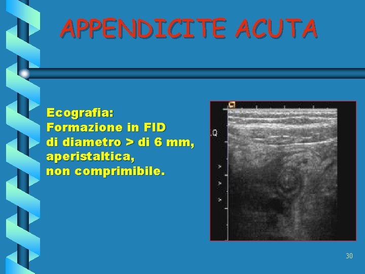 APPENDICITE ACUTA Ecografia: Formazione in FID di diametro > di 6 mm, aperistaltica, non