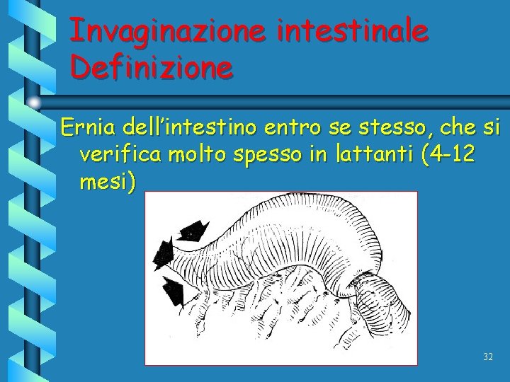Invaginazione intestinale Definizione Ernia dell’intestino entro se stesso, che si verifica molto spesso in