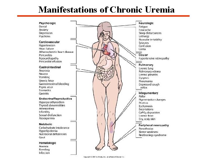 Manifestations of Chronic Uremia Fig. 47 -5 