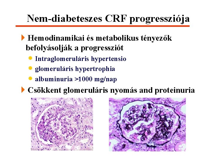 Nem-diabeteszes CRF progressziója 4 Hemodinamikai és metabolikus tényezők befolyásolják a progressziót · Intraglomeruláris hypertensio