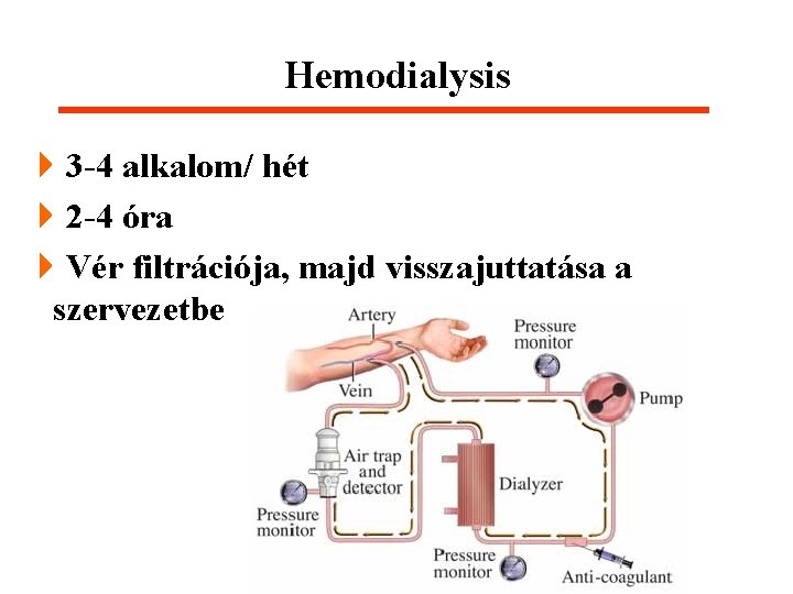 Hemodialysis 43 -4 alkalom/ hét 42 -4 óra 4 Vér filtrációja, majd visszajuttatása a