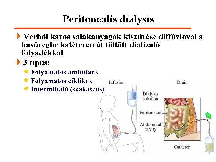 Peritonealis dialysis 4 Vérből káros salakanyagok kiszűrése diffúzióval a hasüregbe katéteren át töltött dializáló