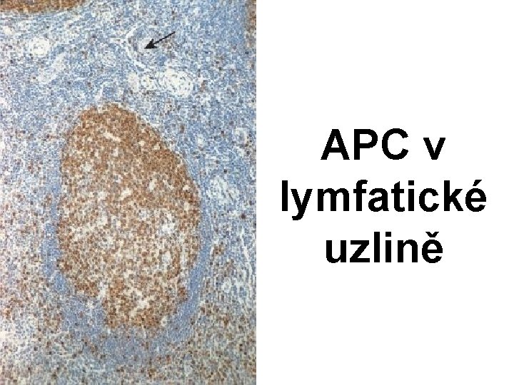 APC v lymfatické uzlině 