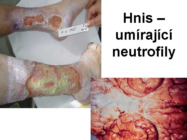 Hnis – umírající neutrofily 