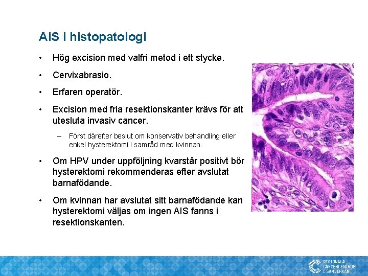 AIS i histopatologi • Hög excision med valfri metod i ett stycke. • Cervixabrasio.