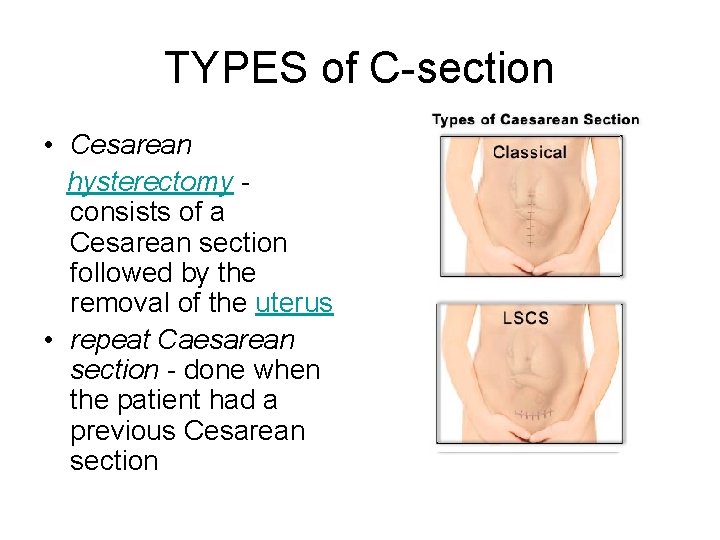 TYPES of C-section • Cesarean hysterectomy consists of a Cesarean section followed by the