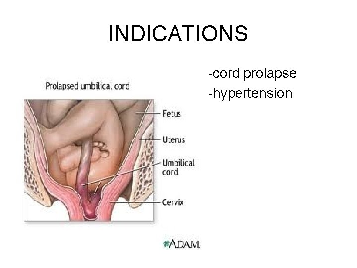 INDICATIONS -cord prolapse -hypertension 