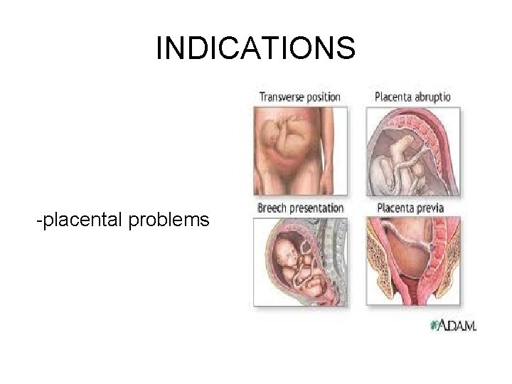 INDICATIONS -placental problems 