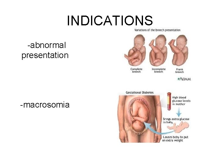 INDICATIONS -abnormal presentation -macrosomia 