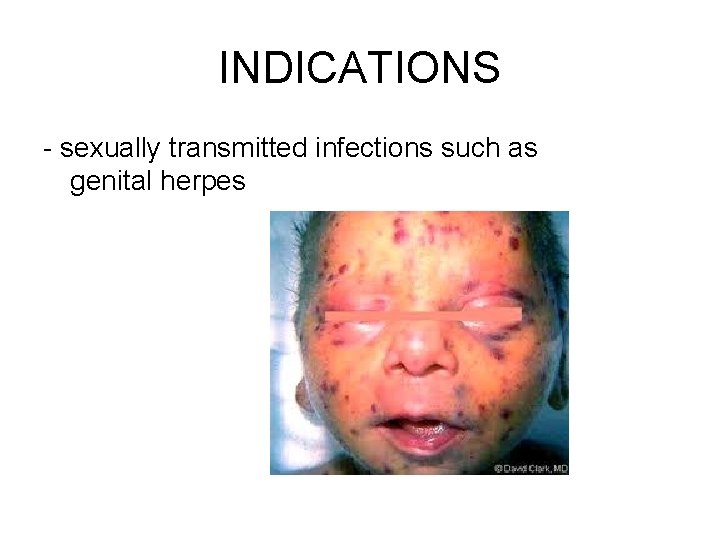 INDICATIONS - sexually transmitted infections such as genital herpes 