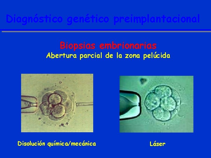 Diagnóstico genético preimplantacional Biopsias embrionarias Abertura parcial de la zona pelúcida Disolución química/mecánica Láser
