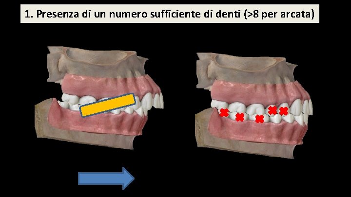 1. Presenza di un numero sufficiente di denti (>8 per arcata) 1. Presenza di un numero sufficiente di denti (>8 per arcata)
