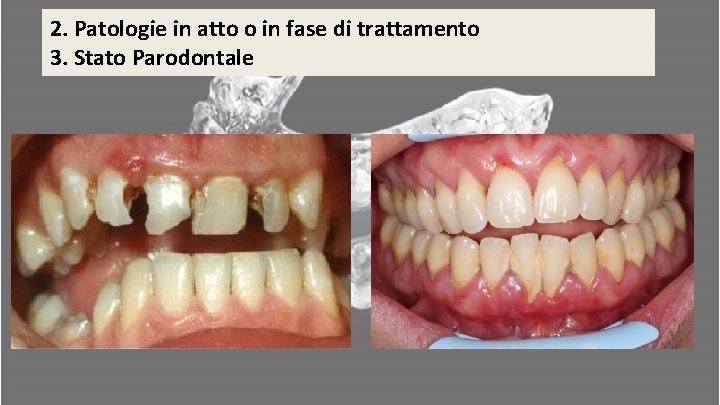 2. Patologie in atto o in fase di trattamento 3. Stato Parodontale 2. Patologie in atto o in fase di trattamento 3. Stato Parodontale