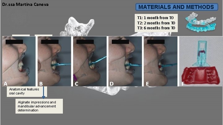 Dr. ssa Martina Caneva MATERIALS AND METHODS T 1: 1 month from T 0 Dr. ssa Martina Caneva MATERIALS AND METHODS T 1: 1 month from T 0