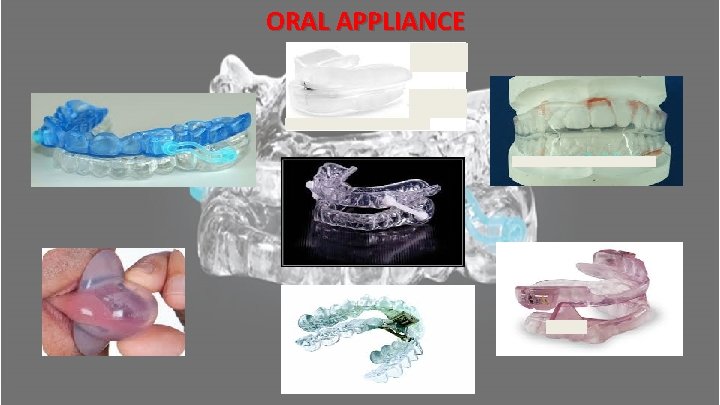 ORAL APPLIANCE ORAL APPLIANCE
