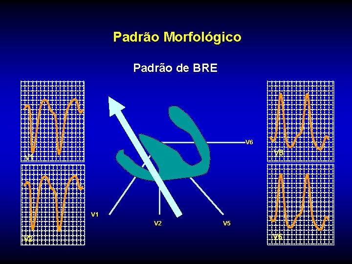 Padrão Morfológico Padrão de BRE V 6 V 1 V 2 V 5 Padrão Morfológico Padrão de BRE V 6 V 1 V 2 V 5