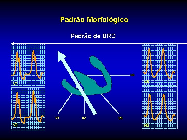 Padrão Morfológico Padrão de BRD V 6 V 5 V 1 V 2 V