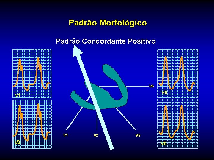 Padrão Morfológico Padrão Concordante Positivo V 6 V 1 V 2 V 5 